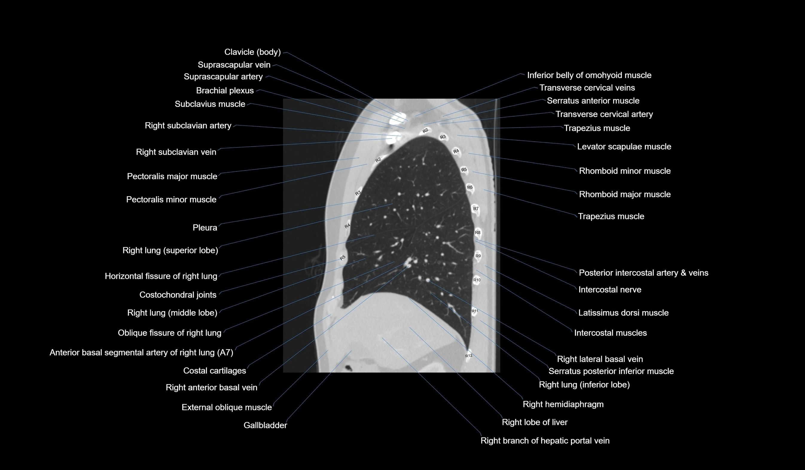 CT chest (thorax) labelled sagittal cross sectional anatomy radiology image-00044.webp